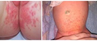 Diaper dermatitis