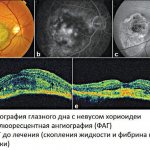 Pigmented nevus of the choroid and its treatment