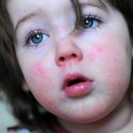 Пищевая аллергия у детей: диагностика