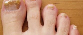 Почему появляется грибок на ногте?