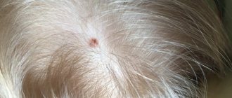 Why does a mole appear on the head? What does it mean and does it require treatment? 