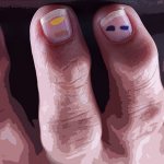 Why do spots appear on nails?