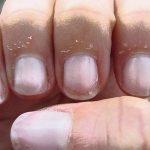 Почему трескаются ногти и кожа вокруг ногтей?