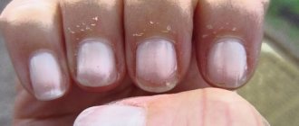 Why do my nails and the skin around my nails crack?