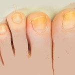 Why do fingernails and toenails turn yellow?