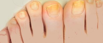 Why do fingernails and toenails turn yellow?