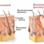 Под мышкой шишка появилась -фурункул