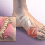 Gout: symptoms and treatment