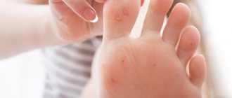 plantar warts