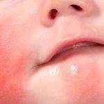 Causes of neurodermatitis in children