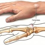 Causes of hygroma