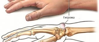 Causes of hygroma