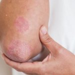 Signs of psoriasis