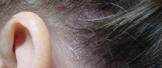 Progressive stage of psoriasis on the scalp