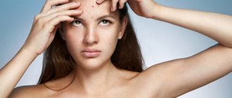 acne on the skin as a liver relapse