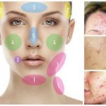 Acne on the face causes by zone