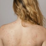 pimples on shoulders