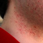 Прыщи после бритья: почему появляются на лице и как избавиться