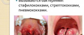 Pimples in the throat as symptoms of diseases: causes, diagnosis, treatment methods