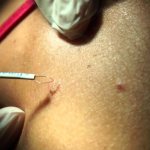 radio wave removal of moles