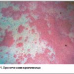 Rice. 1. Chronic urticaria 