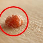 mole wart papilloma: what is the difference