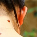 Mole on the left side of the neck