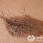 Moles, or pigmented nevi, occur in 90% of people