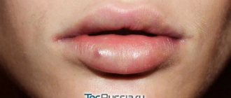 scarring on the lips after contouring