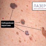 seborrheic keratoma on the skin