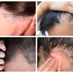 Symptoms of seborrheic dermatitis