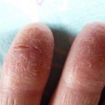 symptoms of peeling fingertips