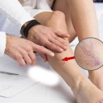 Spider veins on the legs - causes and treatment