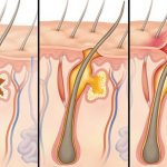 Stages of boil development