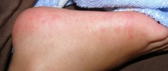 Rash on the palms: causes, symptoms, treatment