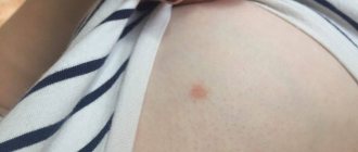 Сыпь под грудью, зуд и красные пятна у женщины: фото, причины, симптомы и лечение