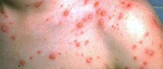 Rash in a child with chickenpox