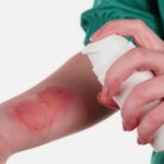 Top 5 universal remedies for burns