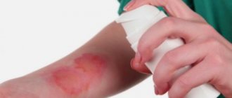 Top 5 universal remedies for burns