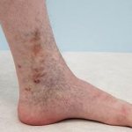 Trophic venous eczema