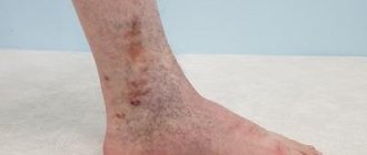 Trophic venous eczema