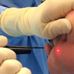 Laser removal of warts