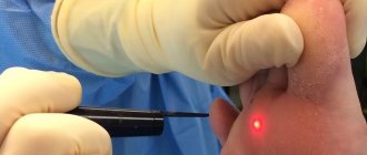 Laser removal of warts