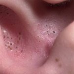 acne in the ear