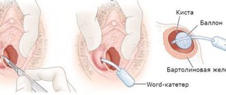 Installation of a word catheter