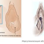 Word catheter placement and marsupialization