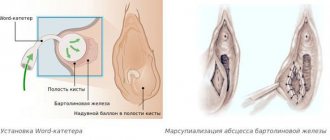 Word catheter placement and marsupialization