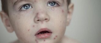 Chickenpox in a child