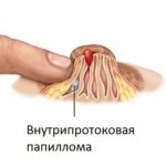 Intraductal papilloma, diagnosis and treatment in St. Petersburg