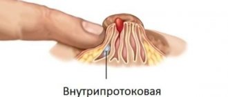 Intraductal papilloma, diagnosis and treatment in St. Petersburg